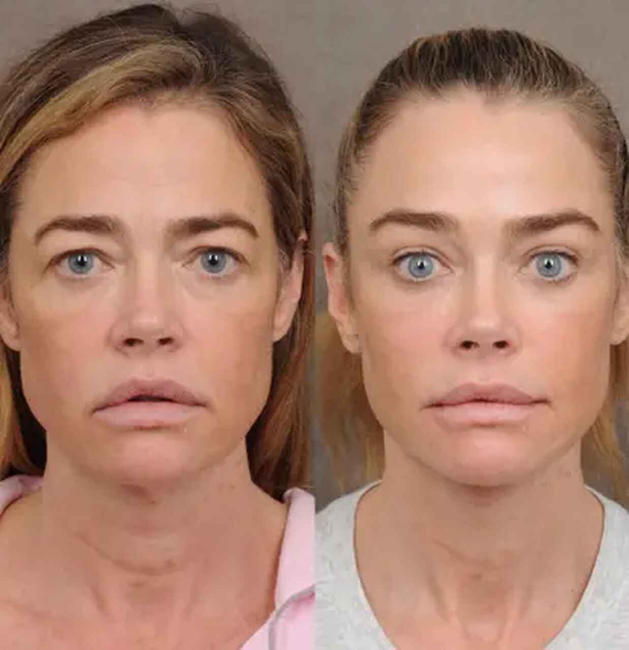Denise Richards impressiona após mostrar antes e depois de lifting facial